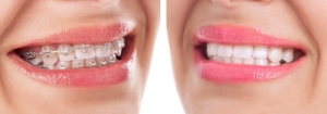 Braces before / after - blog